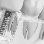 dental implants Bankstown