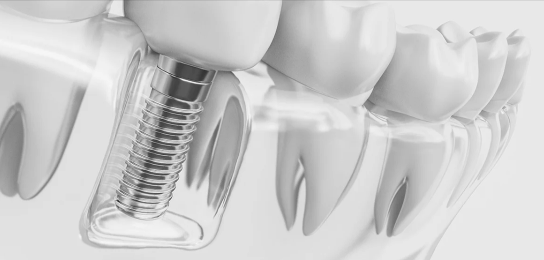 Dental Implant: Know About The Process dental implants Bankstown